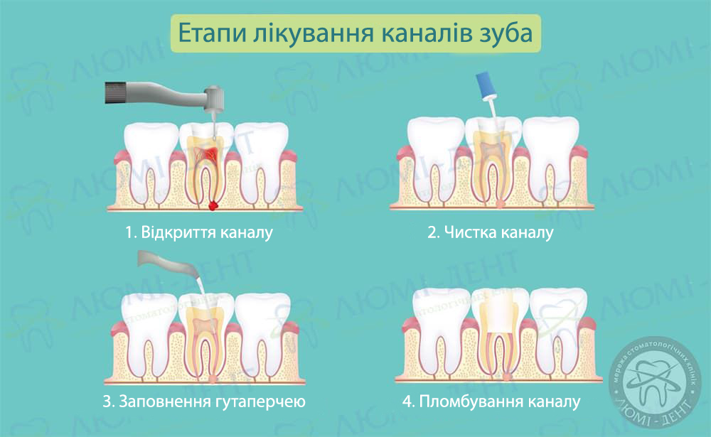 Если болит зуб: как убить нерв в домашних условиях и стоит ли это делать
